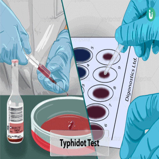 Salmonella Typhi IgG and IgM (Typhi Dot)